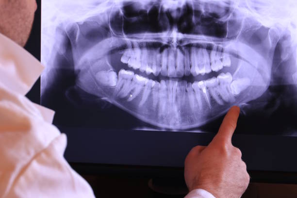 Best Emergency Dental Extractions in Bellevue, ID
